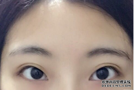 什么是間歇性外斜視，需要保健嗎